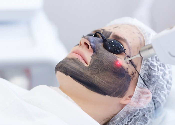 Carbon peel treatment in Delhi